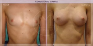 Before and after images of a breast augmentation procedure
